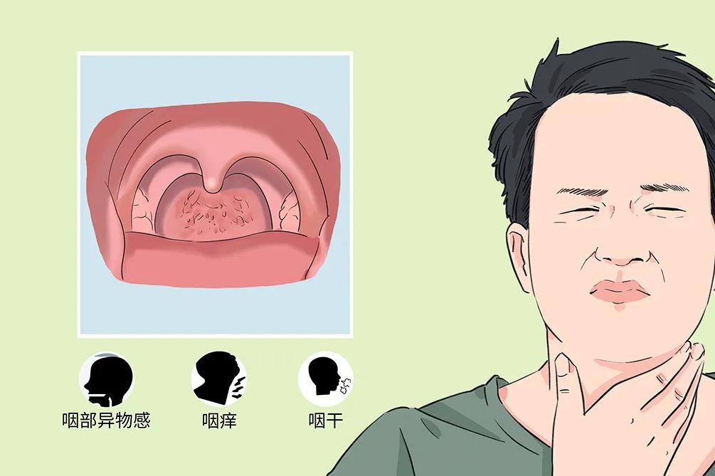 慢性咽炎的困擾：咽干、咽痛、咽部異物感(圖2)