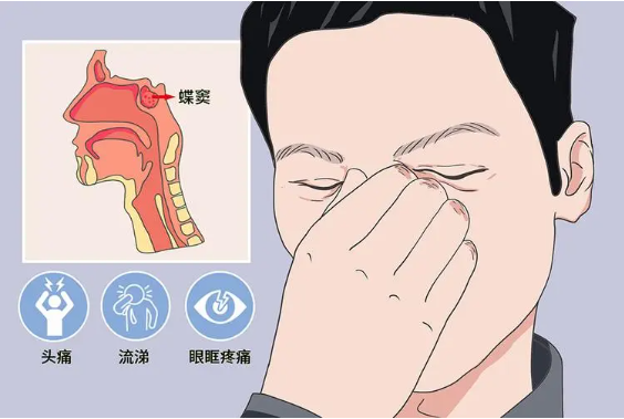 頭疼、眼痛雖小，卻可能是蝶竇炎發(fā)出的警告信號！(圖1)