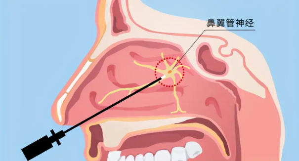 頭疼、眼痛雖小，卻可能是蝶竇炎發(fā)出的警告信號！(圖2)